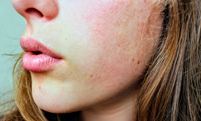 6 home remedies will help you fix your dry skin this winter